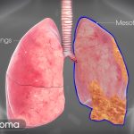 Mesothelioma - A Rare Form of Cancer. Your health should be your number one priority. You should never ignore your health.