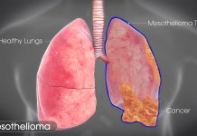 Mesothelioma – A Rare Form of Cancer Mesothelioma - A Rare Form of Cancer. Your health should be your number one priority. You should never ignore your health.