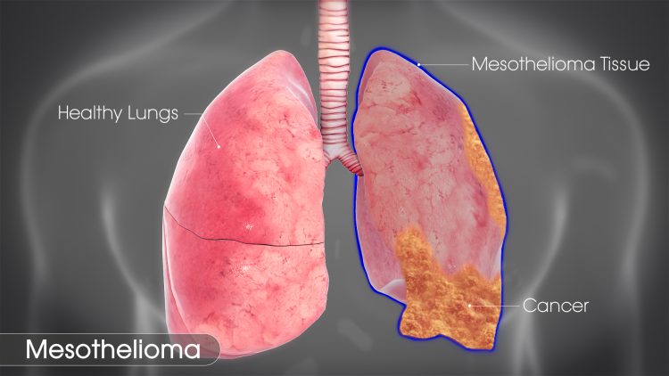 Mesothelioma - A Rare Form of Cancer. Your health should be your number one priority. You should never ignore your health.